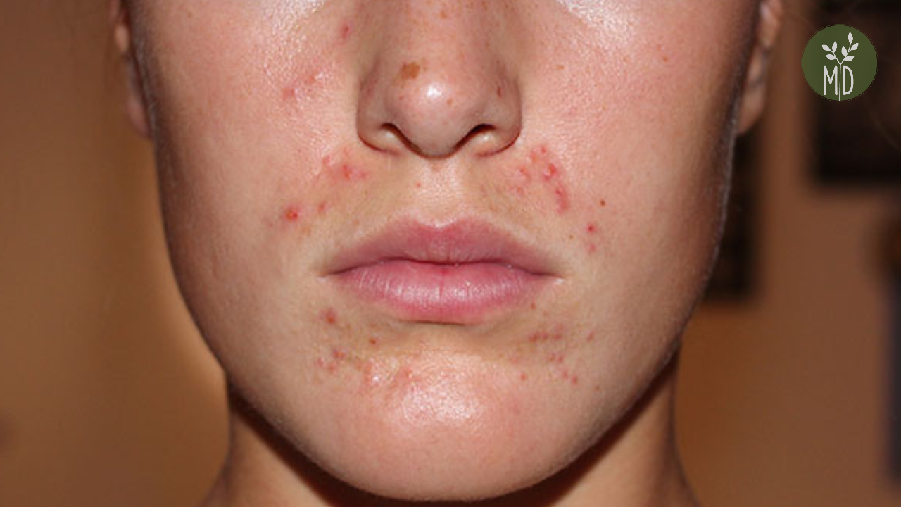 dermatitis vörös foltok az arcon aki likopiddal kezelte a pikkelysmr